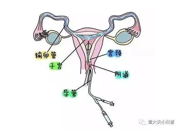 灌肠与输卵管通畅关系解析，时间因素的重要性